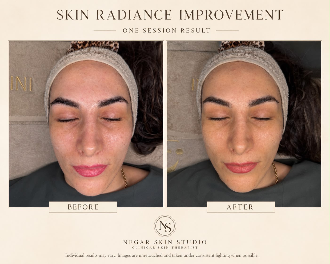 Skin radiance improvement one session before and after result