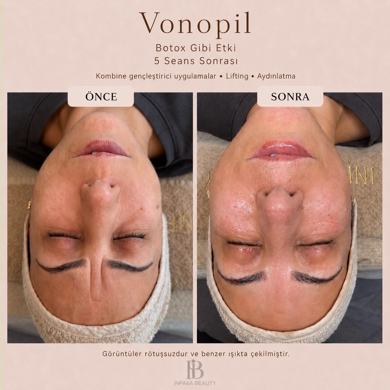 Combined rejuvenating treatments before and after result