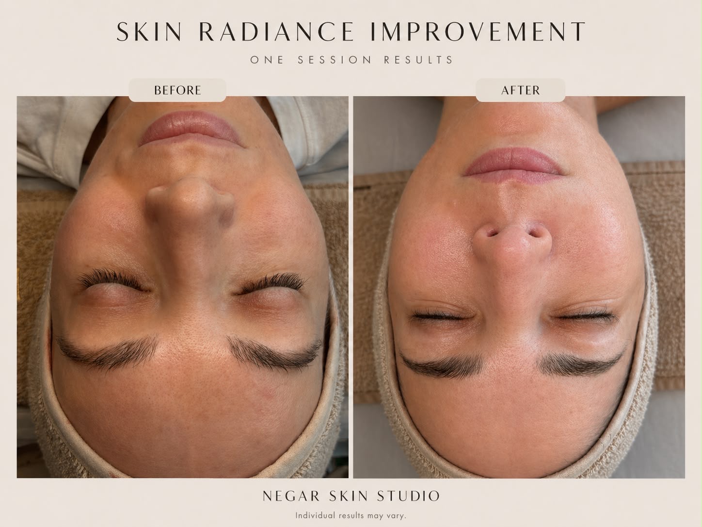 Skin radiance improvement one session before and after result