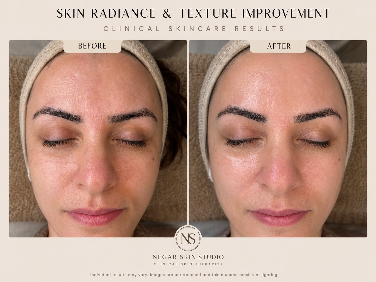 Skin radiance and texture improvement before and after result